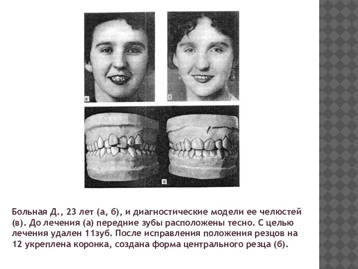 Больная Д., 23 лет (а, б), и диагностические модели ее челюстей