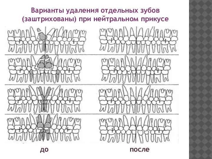 Варианты удаления отдельных зубов (заштрихованы) при нейтральном прикусе до после