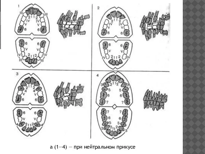 а (1—4) — при нейтральном прикусе