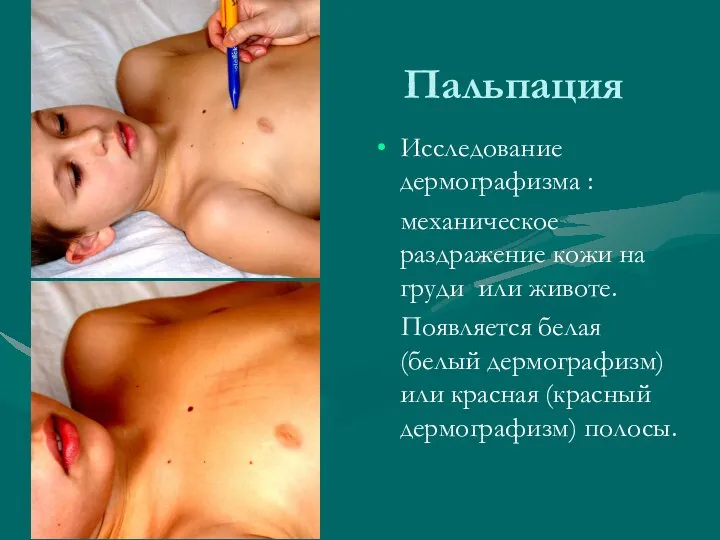 Пальпация Исследование дермографизма : механическое раздражение кожи на груди или животе.