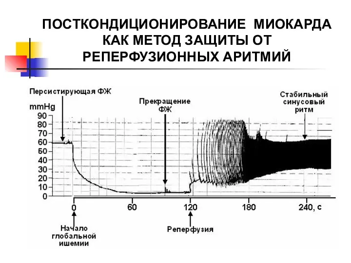 ПОСТКОНДИЦИОНИРОВАНИЕ МИОКАРДА КАК МЕТОД ЗАЩИТЫ ОТ РЕПЕРФУЗИОННЫХ АРИТМИЙ