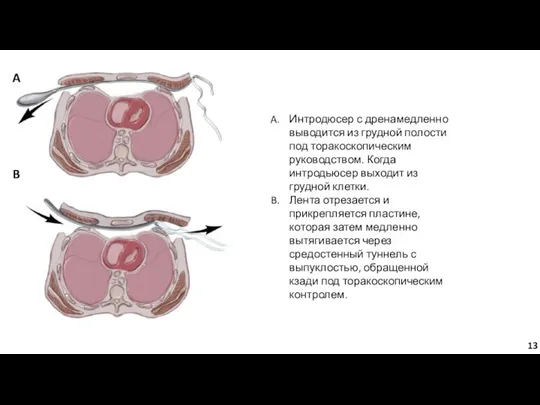 Интродюсер с дренамедленно выводится из грудной полости под торакоскопическим руководством. Когда