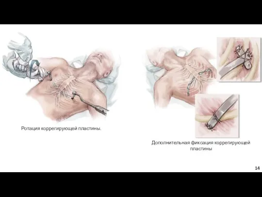 Ротация коррегирующей пластины. Дополнительная фиксация коррегирующей пластины 14