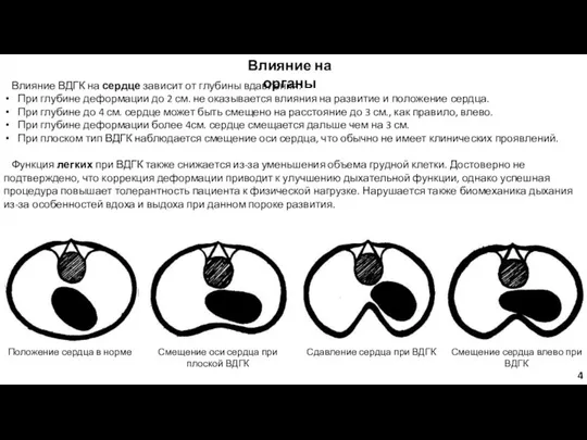 Влияние на органы Влияние ВДГК на сердце зависит от глубины вдавления:
