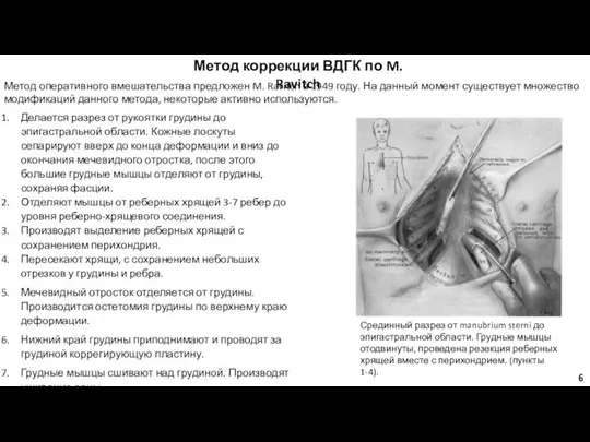 Метод коррекции ВДГК по M. Ravitch Метод оперативного вмешательства предложен M.