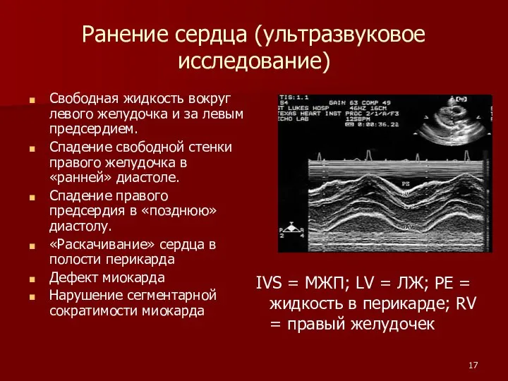 Ранение сердца (ультразвуковое исследование) Свободная жидкость вокруг левого желудочка и за