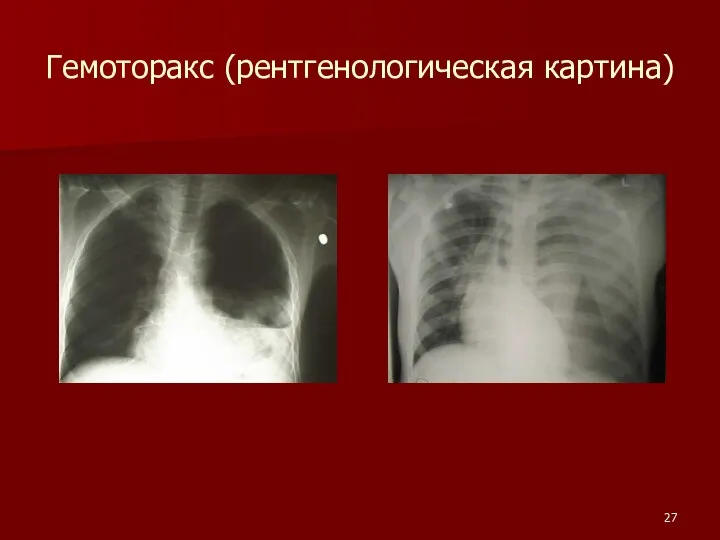 Гемоторакс (рентгенологическая картина)