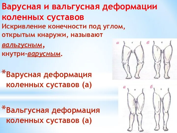 Варусная и вальгусная деформации коленных суставов Искривление конечности под углом, открытым