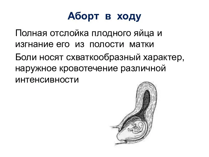 Аборт в ходу Полная отслойка плодного яйца и изгнание его из