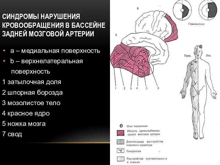 СИНДРОМЫ НАРУШЕНИЯ КРОВООБРАЩЕНИЯ В БАССЕЙНЕ ЗАДНЕЙ МОЗГОВОЙ АРТЕРИИ a – медиальная