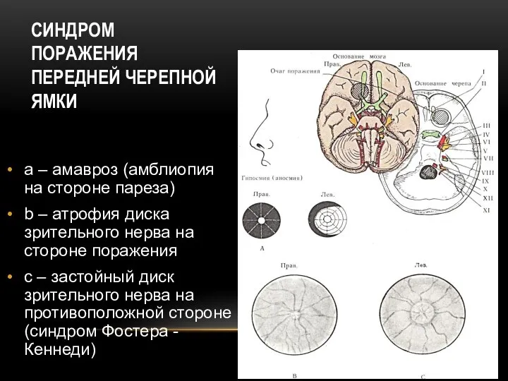 СИНДРОМ ПОРАЖЕНИЯ ПЕРЕДНЕЙ ЧЕРЕПНОЙ ЯМКИ а – амавроз (амблиопия на стороне