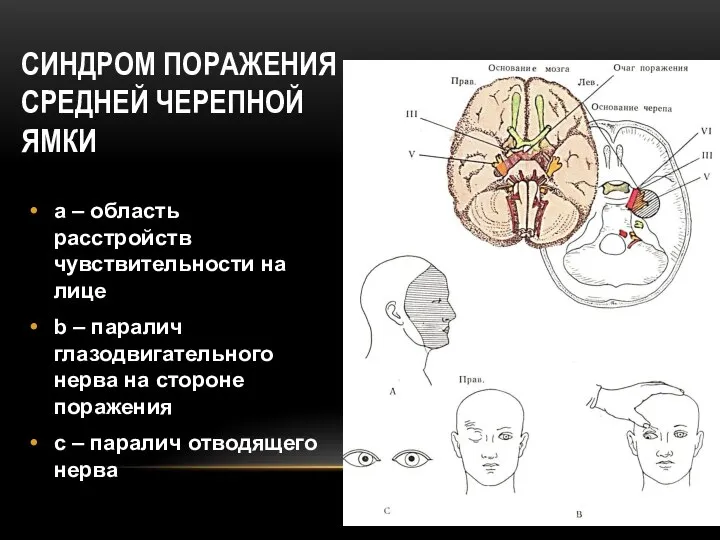 СИНДРОМ ПОРАЖЕНИЯ СРЕДНЕЙ ЧЕРЕПНОЙ ЯМКИ a – область расстройств чувствительности на