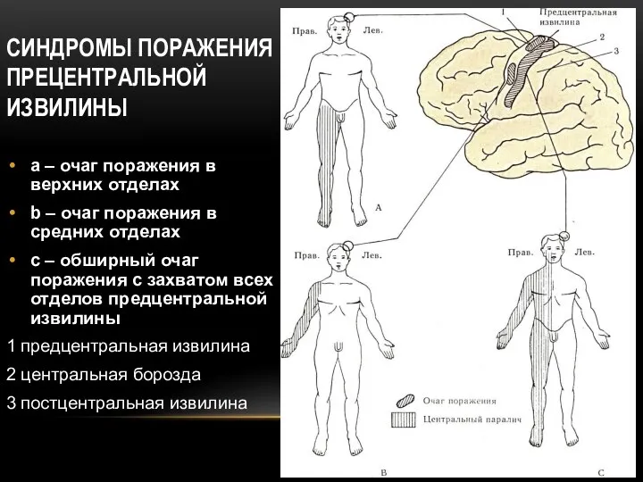 СИНДРОМЫ ПОРАЖЕНИЯ ПРЕЦЕНТРАЛЬНОЙ ИЗВИЛИНЫ а – очаг поражения в верхних отделах