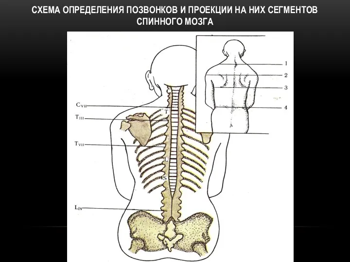 СХЕМА ОПРЕДЕЛЕНИЯ ПОЗВОНКОВ И ПРОЕКЦИИ НА НИХ СЕГМЕНТОВ СПИННОГО МОЗГА