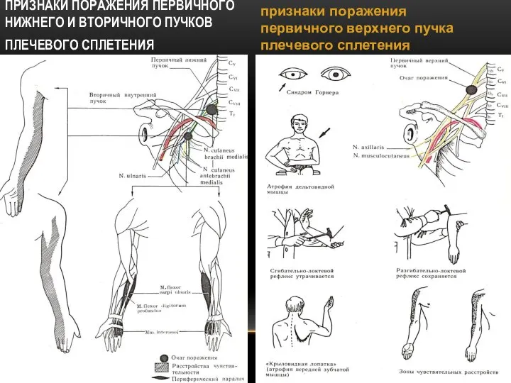 ПРИЗНАКИ ПОРАЖЕНИЯ ПЕРВИЧНОГО НИЖНЕГО И ВТОРИЧНОГО ПУЧКОВ ПЛЕЧЕВОГО СПЛЕТЕНИЯ признаки поражения первичного верхнего пучка плечевого сплетения