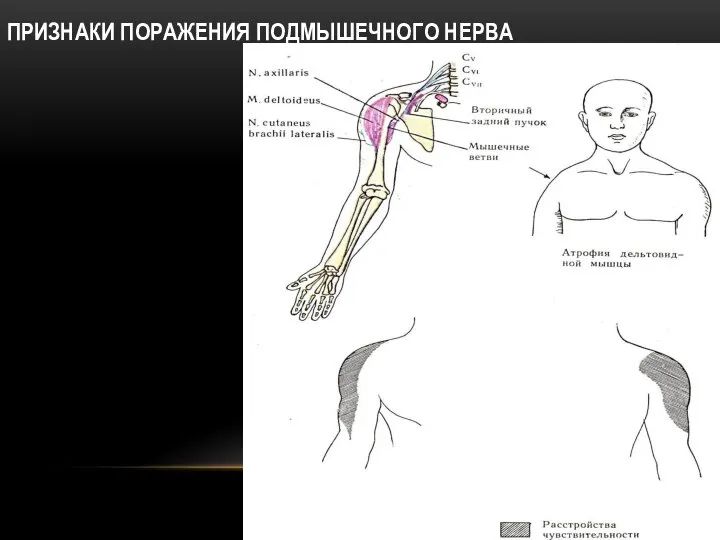 ПРИЗНАКИ ПОРАЖЕНИЯ ПОДМЫШЕЧНОГО НЕРВА