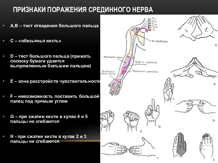 А,В – тест отведения большого пальца С – «обезьянья кисть» D