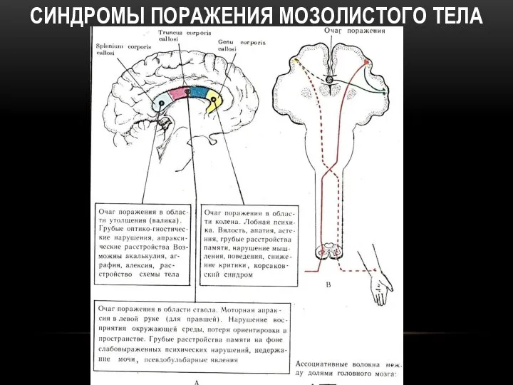 СИНДРОМЫ ПОРАЖЕНИЯ МОЗОЛИСТОГО ТЕЛА