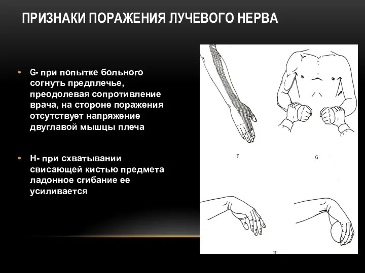 G- при попытке больного согнуть предплечье, преодолевая сопротивление врача, на стороне