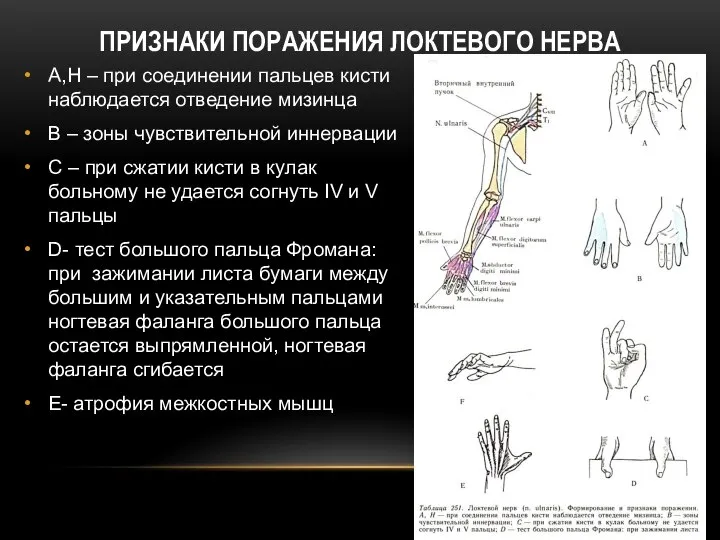 А,Н – при соединении пальцев кисти наблюдается отведение мизинца В –