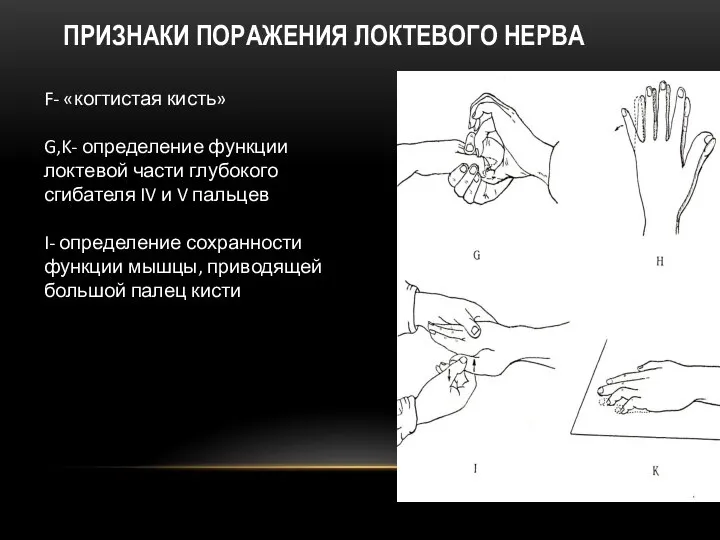 ПРИЗНАКИ ПОРАЖЕНИЯ ЛОКТЕВОГО НЕРВА F- «когтистая кисть» G,K- определение функции локтевой