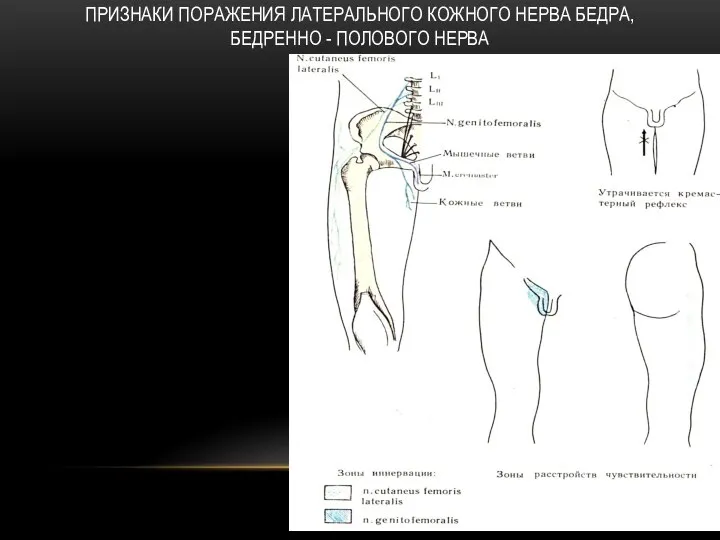 ПРИЗНАКИ ПОРАЖЕНИЯ ЛАТЕРАЛЬНОГО КОЖНОГО НЕРВА БЕДРА, БЕДРЕННО - ПОЛОВОГО НЕРВА