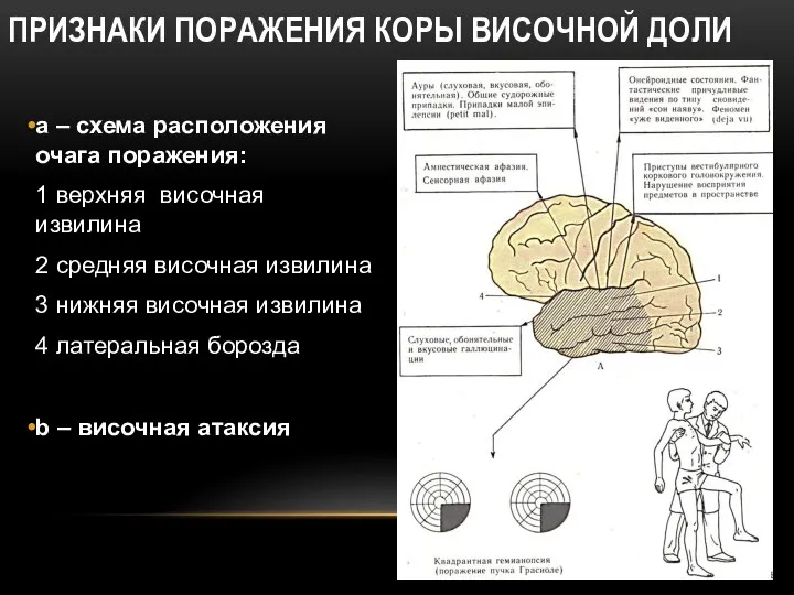 ПРИЗНАКИ ПОРАЖЕНИЯ КОРЫ ВИСОЧНОЙ ДОЛИ a – схема расположения очага поражения: