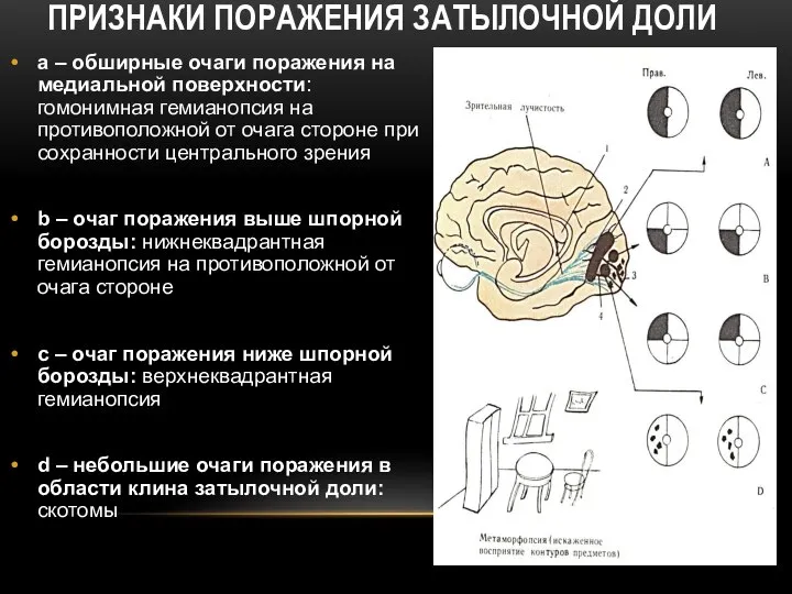 ПРИЗНАКИ ПОРАЖЕНИЯ ЗАТЫЛОЧНОЙ ДОЛИ а – обширные очаги поражения на медиальной