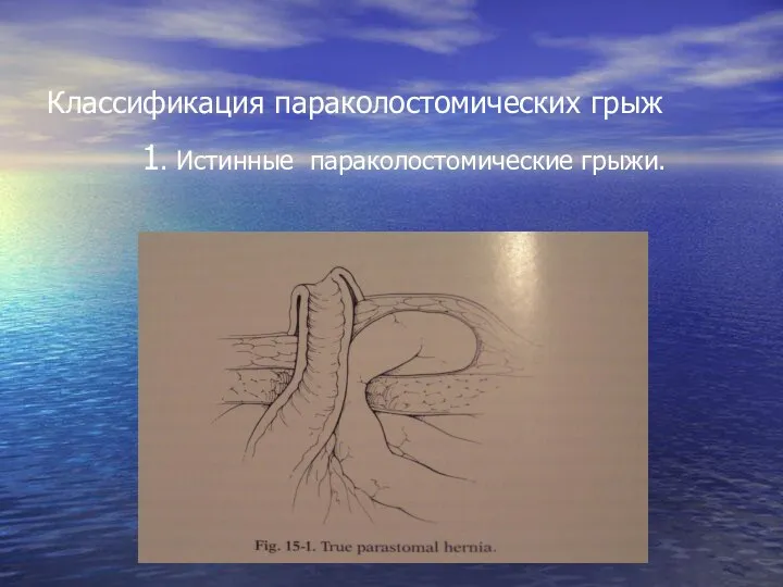 Классификация параколостомических грыж 1. Истинные параколостомические грыжи.