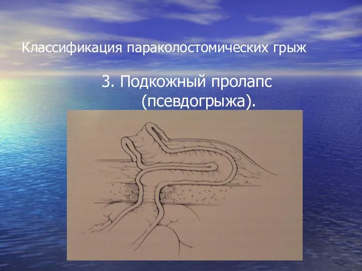 Классификация параколостомических грыж 3. Подкожный пролапс (псевдогрыжа).