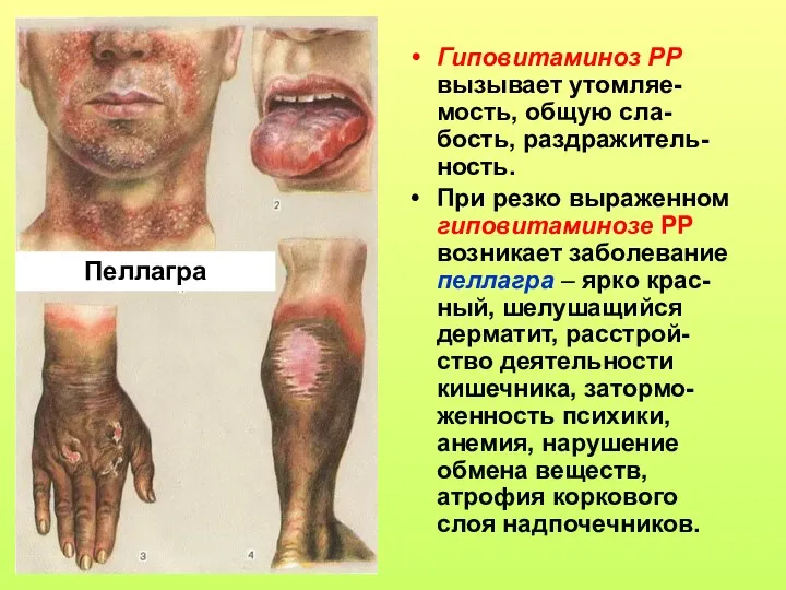 Гиповитаминоз РР вызывает утомляе-мость, общую сла-бость, раздражитель-ность. При резко выраженном гиповитаминозе