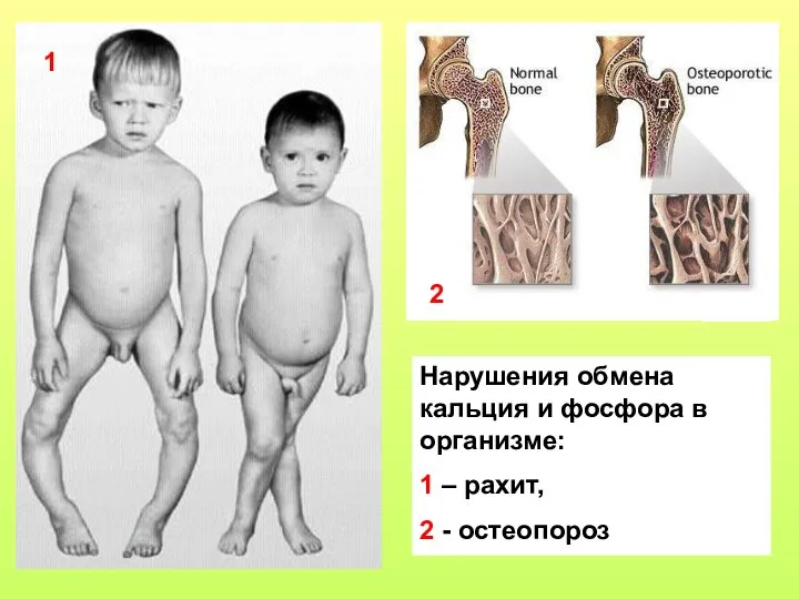 1 2 Нарушения обмена кальция и фосфора в организме: 1 – рахит, 2 - остеопороз