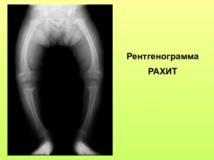 Рентгенограмма РАХИТ