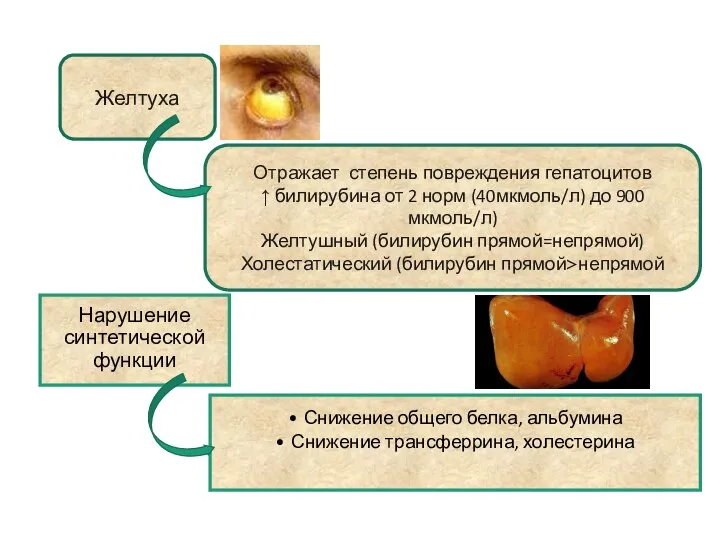 Желтуха Отражает степень повреждения гепатоцитов ↑ билирубина от 2 норм (40мкмоль/л)