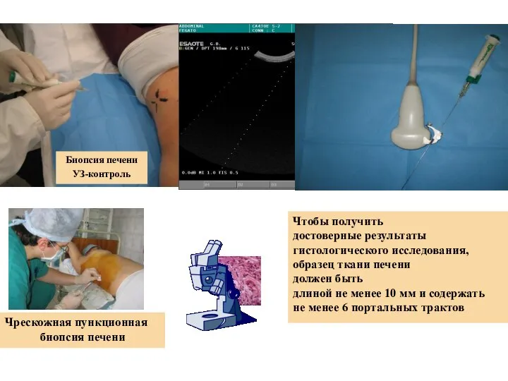 Биопсия печени УЗ-контроль Чтобы получить достоверные результаты гистологического исследования, образец ткани