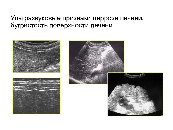 Ультразвуковые признаки цирроза печени: бугристость поверхности печени