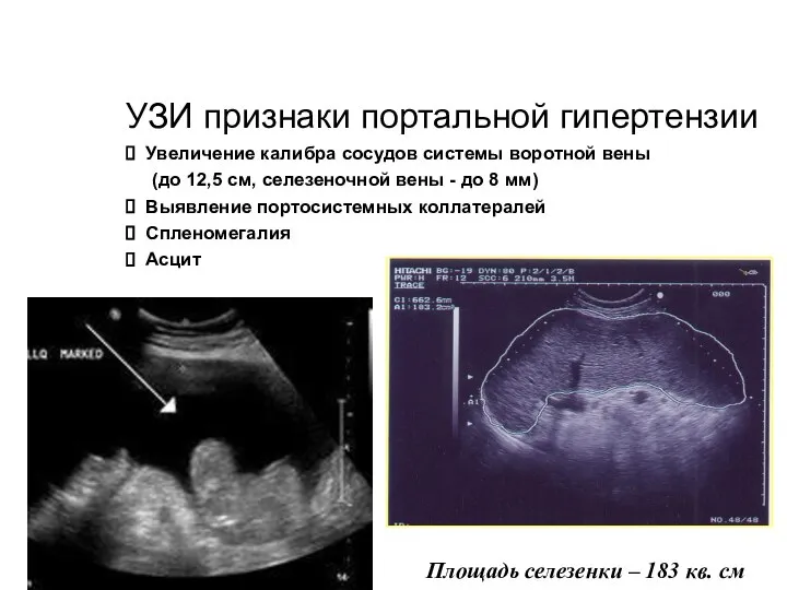 УЗИ признаки портальной гипертензии Увеличение калибра сосудов системы воротной вены (до