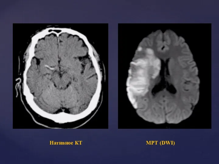 Нативное КТ МРТ (DWI)