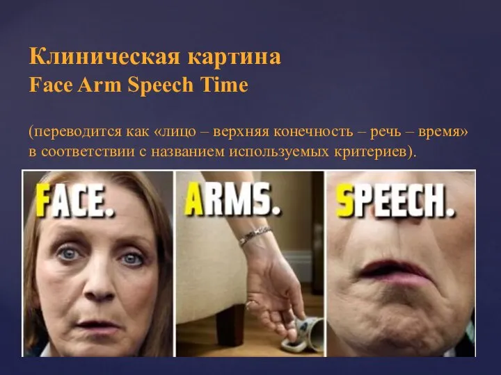 Клиническая картина Face Arm Speech Time (переводится как «лицо – верхняя