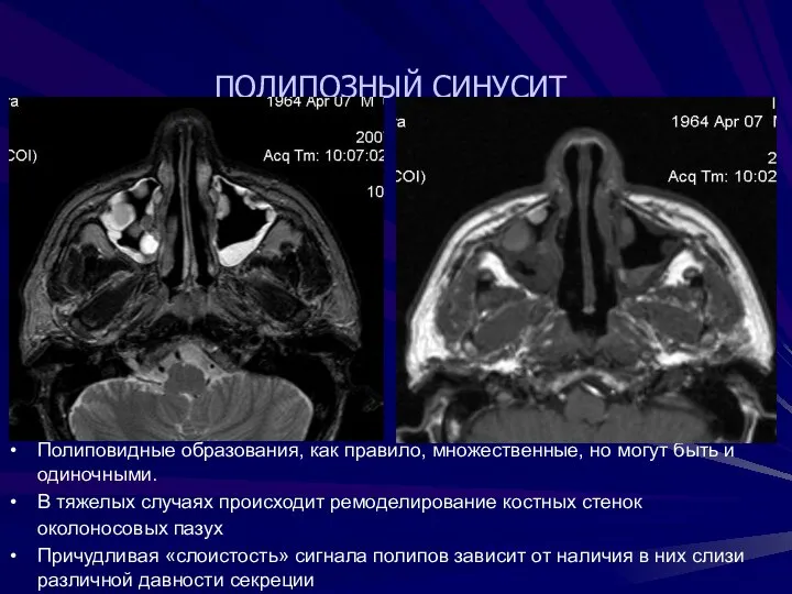 ПОЛИПОЗНЫЙ СИНУСИТ Полиповидные образования, как правило, множественные, но могут быть и