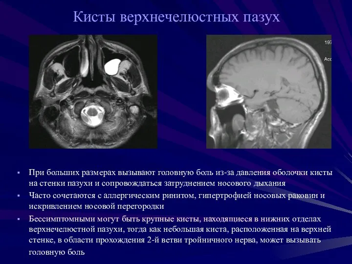 Кисты верхнечелюстных пазух При больших размерах вызывают головную боль из-за давления