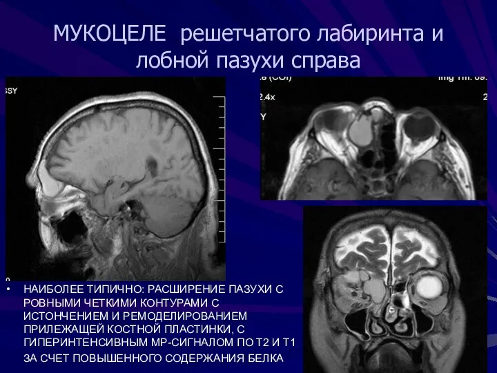 МУКОЦЕЛЕ решетчатого лабиринта и лобной пазухи справа НАИБОЛЕЕ ТИПИЧНО: РАСШИРЕНИЕ ПАЗУХИ