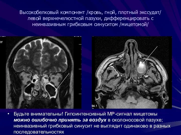 Высокобелковый компонент /кровь, гной, плотный экссудат/ левой верхнечелюстной пазухи, дифференцировать с