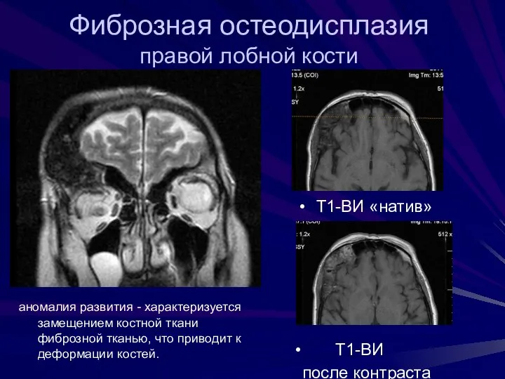 Фиброзная остеодисплазия правой лобной кости аномалия развития - характеризуется замещением костной