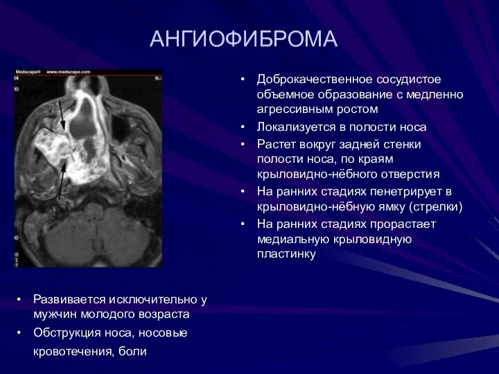 Доброкачественное сосудистое объемное образование с медленно агрессивным ростом Локализуется в полости