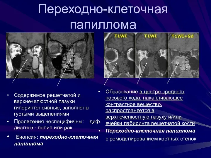 Содержимое решетчатой и верхнечелюстной пазухи гиперинтенсивные, заполнены густыми выделениями. Проявления неспецифичны: