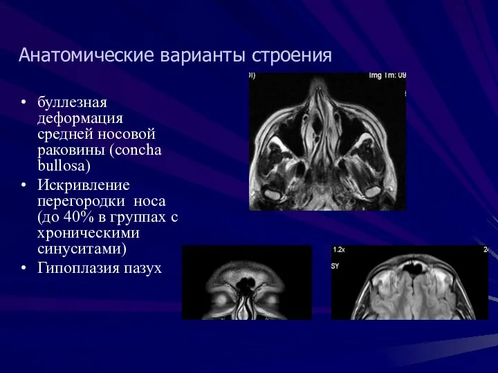 Анатомические варианты строения буллезная деформация средней носовой раковины (concha bullosa) Искривление