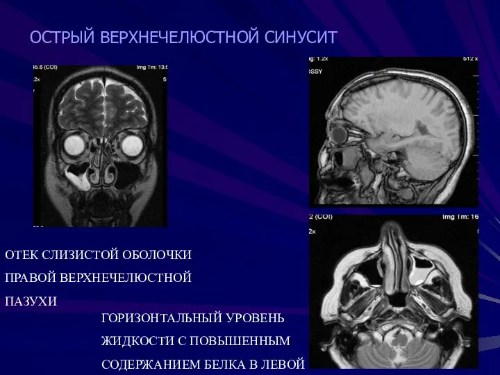 ОСТРЫЙ ВЕРХНЕЧЕЛЮСТНОЙ СИНУСИТ ОТЕК СЛИЗИСТОЙ ОБОЛОЧКИ ПРАВОЙ ВЕРХНЕЧЕЛЮСТНОЙ ПАЗУХИ ГОРИЗОНТАЛЬНЫЙ УРОВЕНЬ