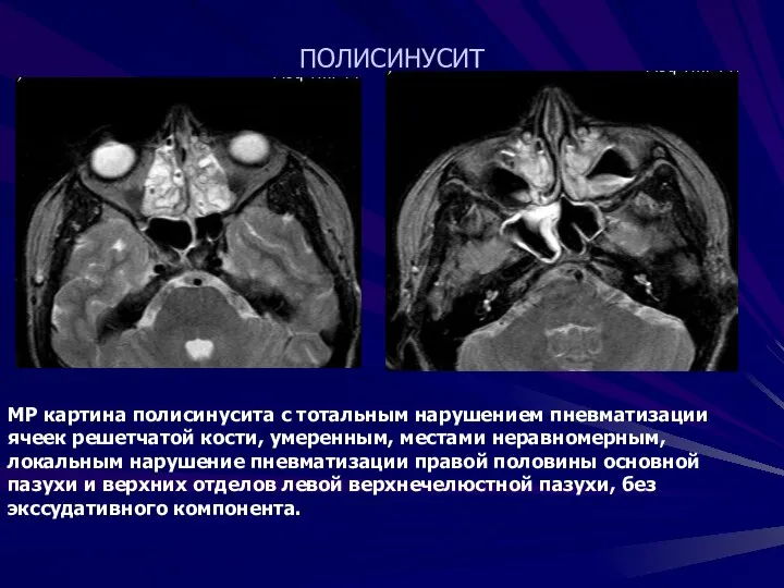 МР картина полисинусита с тотальным нарушением пневматизации ячеек решетчатой кости, умеренным,