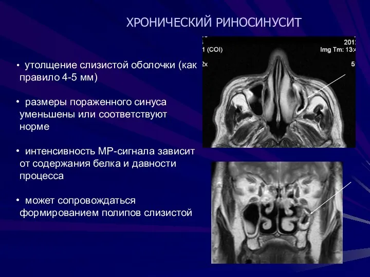 ХРОНИЧЕСКИЙ РИНОСИНУСИТ утолщение слизистой оболочки (как правило 4-5 мм) размеры пораженного